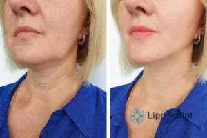 Double chin before and after Hi-Fu treatment 4 Book your double chin treatment Rutland today! We are here to help!