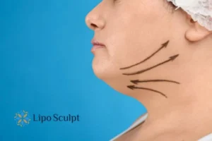 Double chin before and after Hi-Fu treatment 3 Boost your confidence with a Double chin treatment Rutland