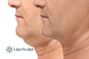 Double chin before and after Hi-Fu treatment 2 Double chin treatment Rutland from Lipo Sculpt - feel more confident today!