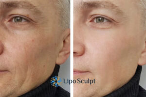 How to Fight Aging Symptoms 3 Fight Aging Symptoms Rutland With HIFU and Morpheus8 Today!