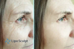 How to Fight Aging Symptoms 2 Do you want to Fight Aging Symptoms Rutland? Contact Lipo Sculpt today!