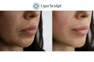 Explaining Morpheus8 And What It Can Do For You 4 Morpheus8 Rutland the best results - call our team today!