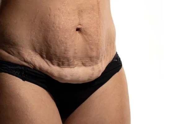 Lost the Weight but Not the Loose Skin? 1 image of womans stomach after weight loss showing loose skin Rutland